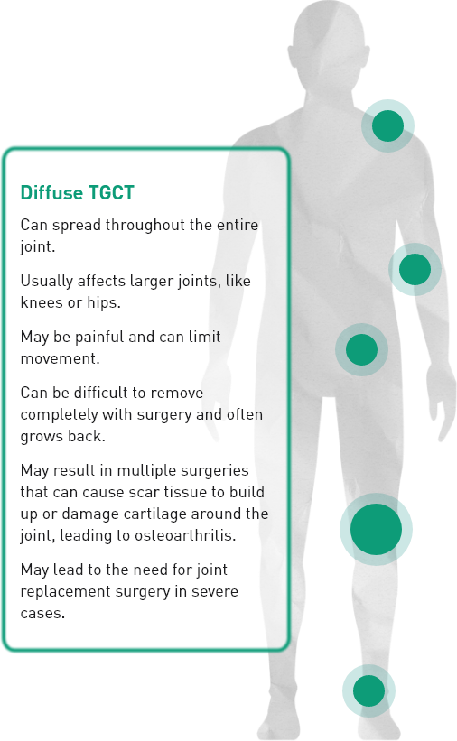 Image representing common locations of diffuse TGCT in the body