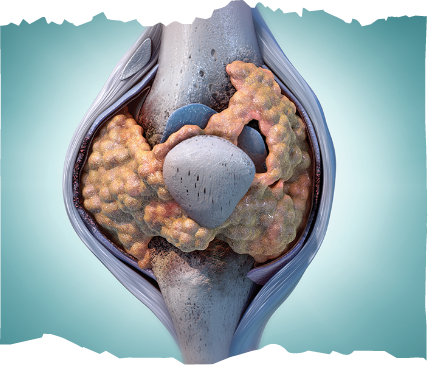 A TGCT tumor forming